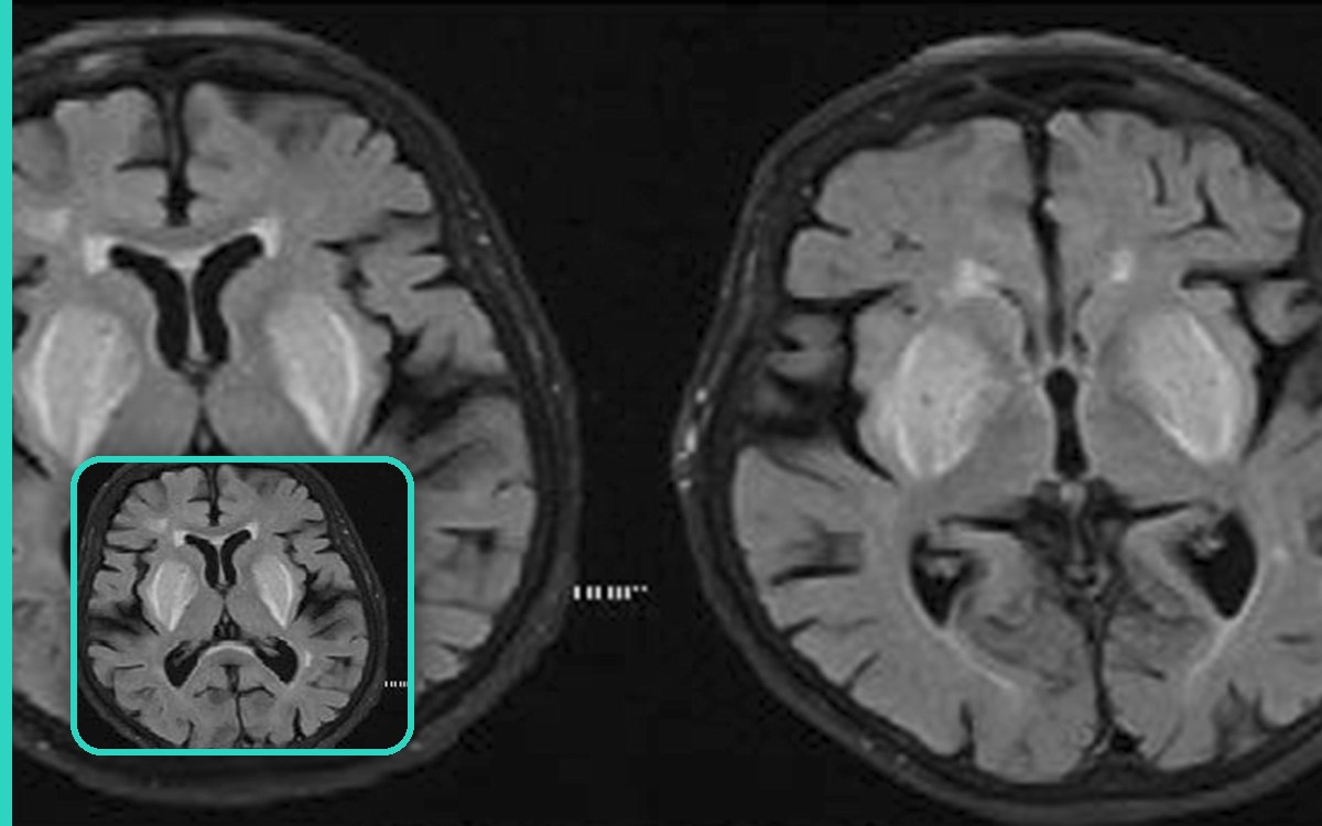 Axial FLAIR brain MRI